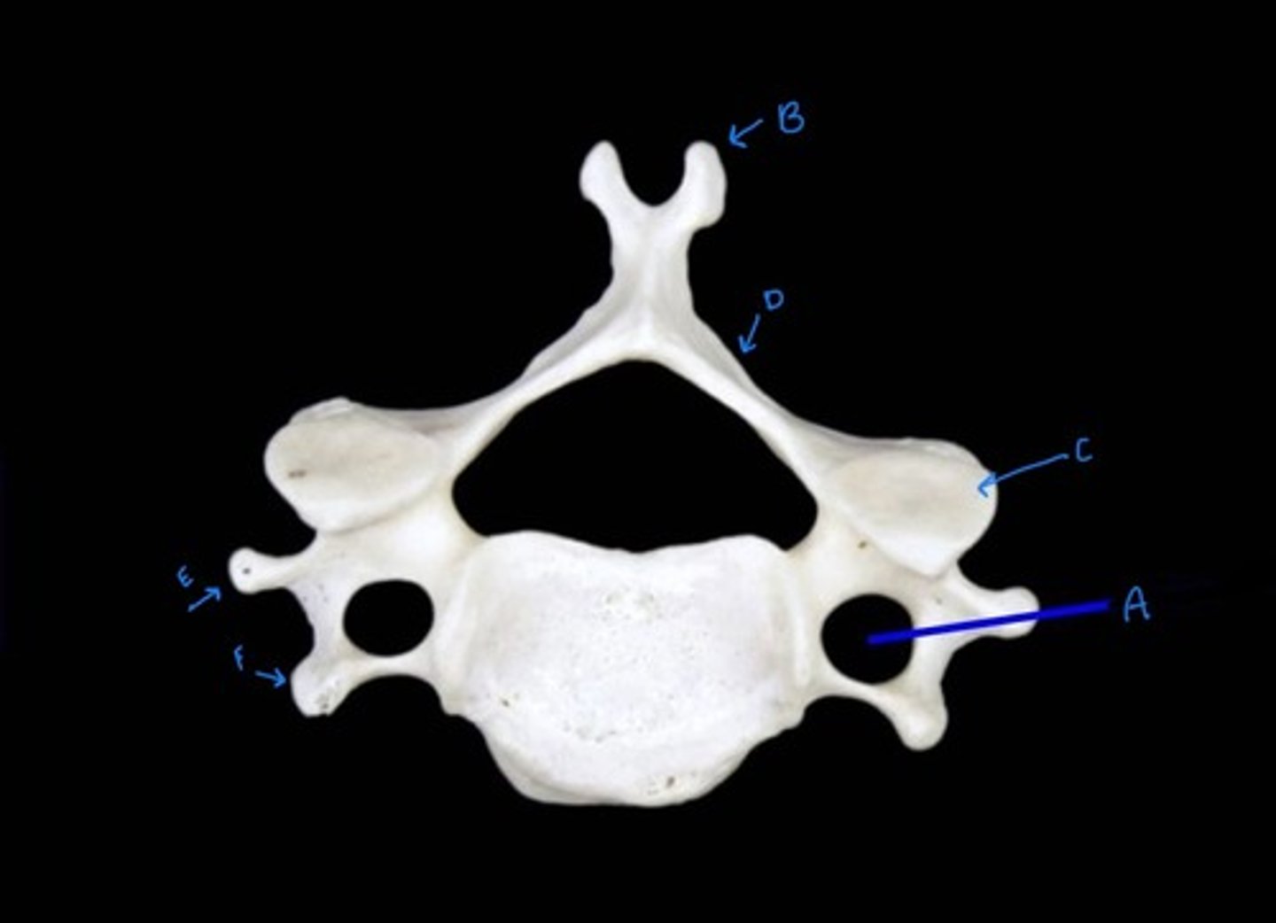 <p>What is "F" on the cervical vertebrae</p>