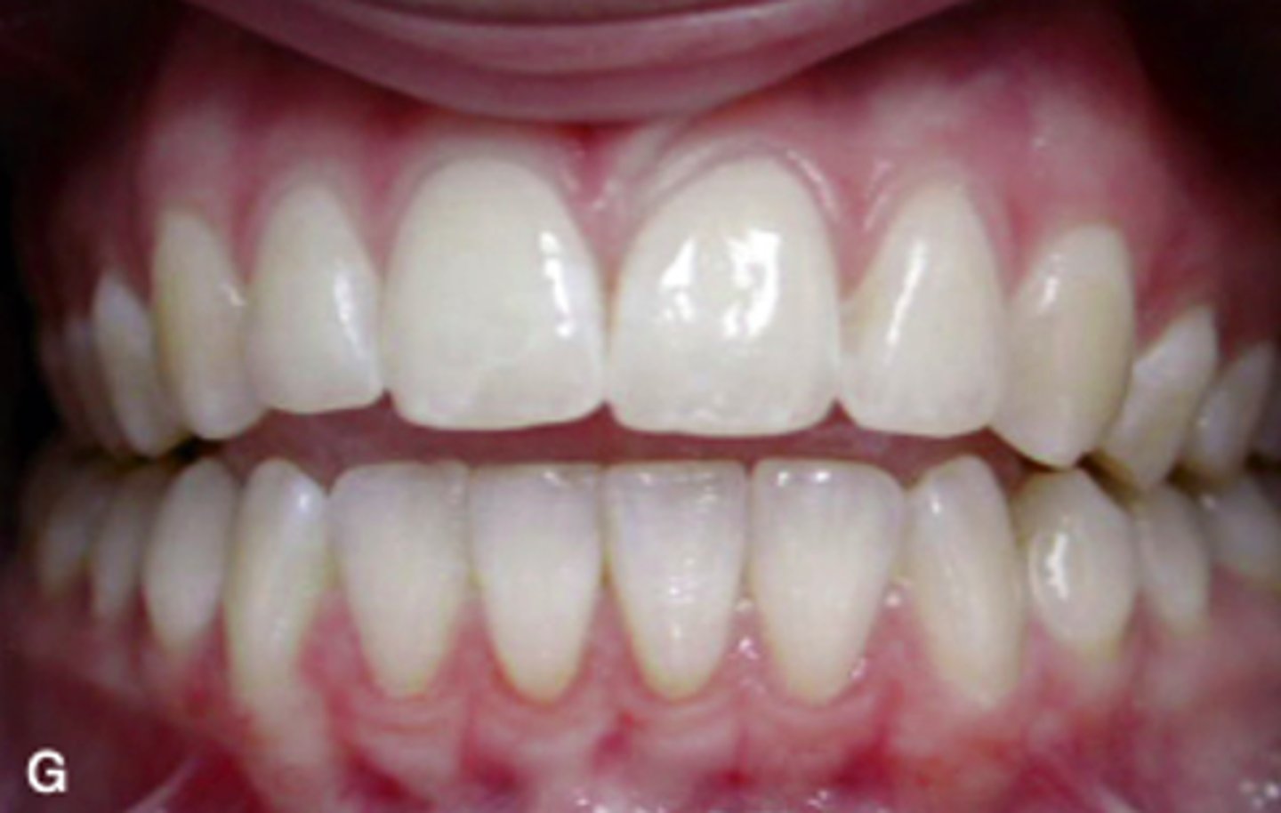<p>ID the occlusion classification:</p>