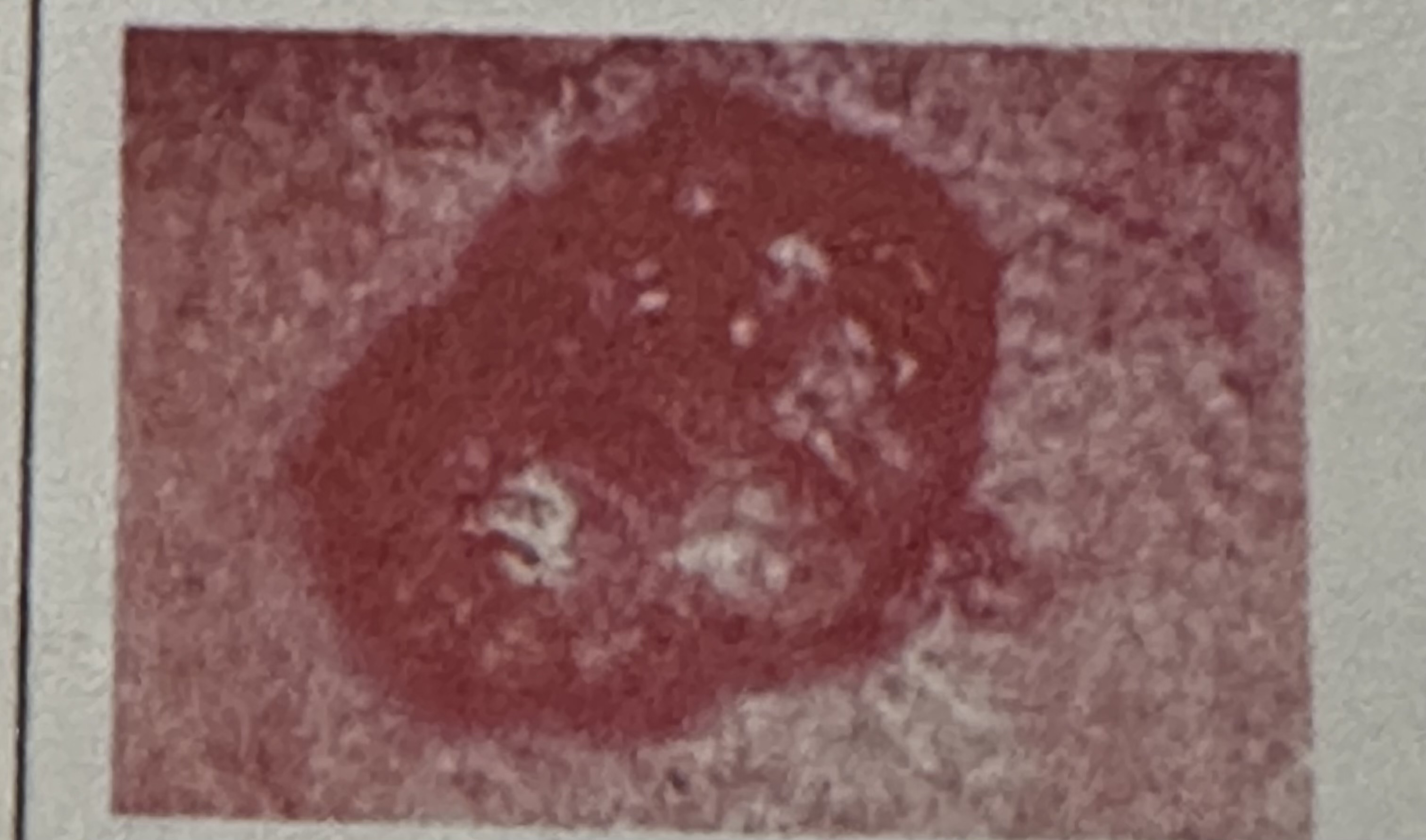 <p>Clinically, how is basal cell carcinoma of the skin typically described?</p>