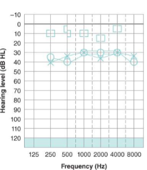 <p>What type of hearing loss is this ad describe the results?</p>