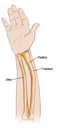 <p>fracture due to the bending of the bone</p>