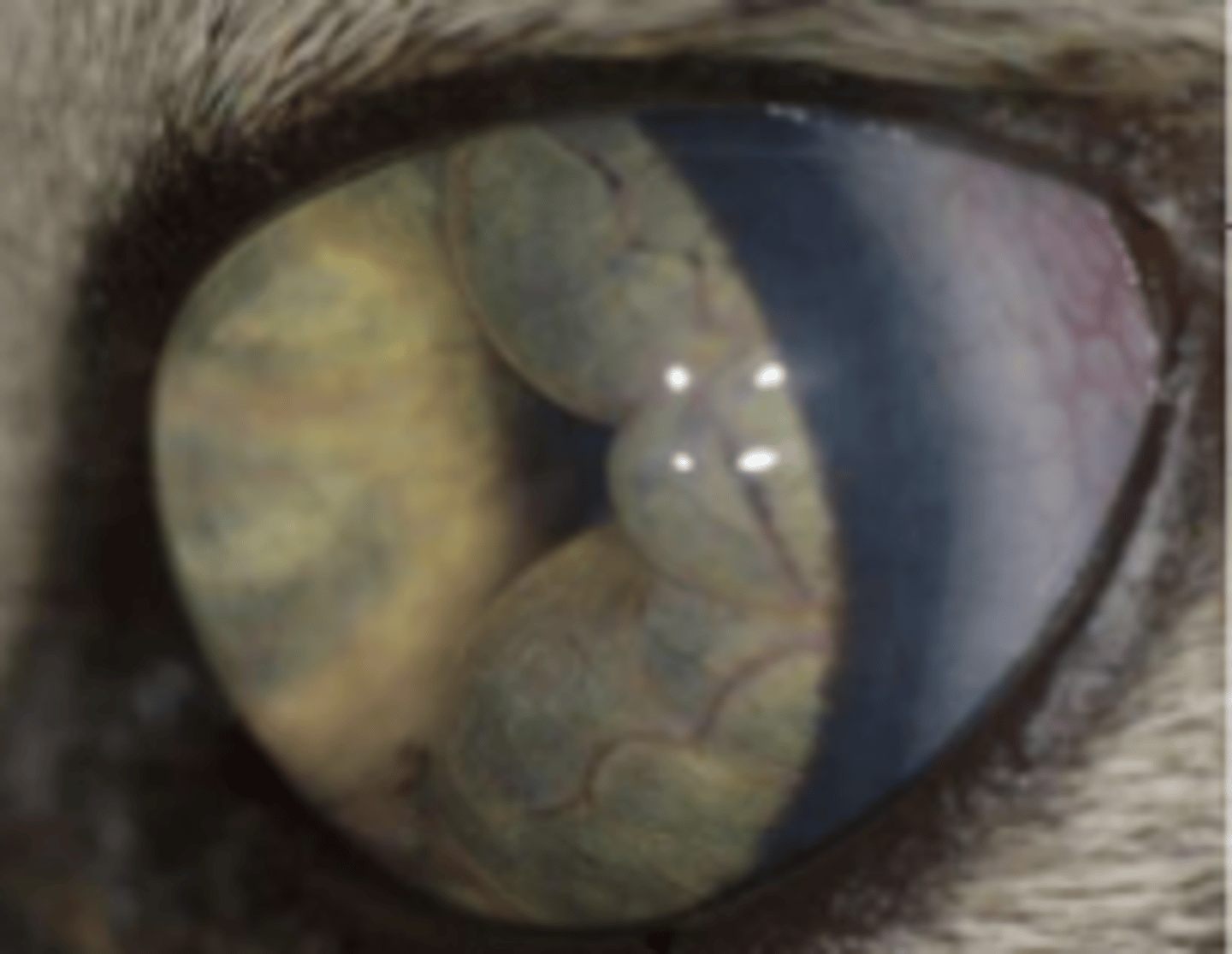 <p>- Posterior synechia: adherence of iris to lens</p>