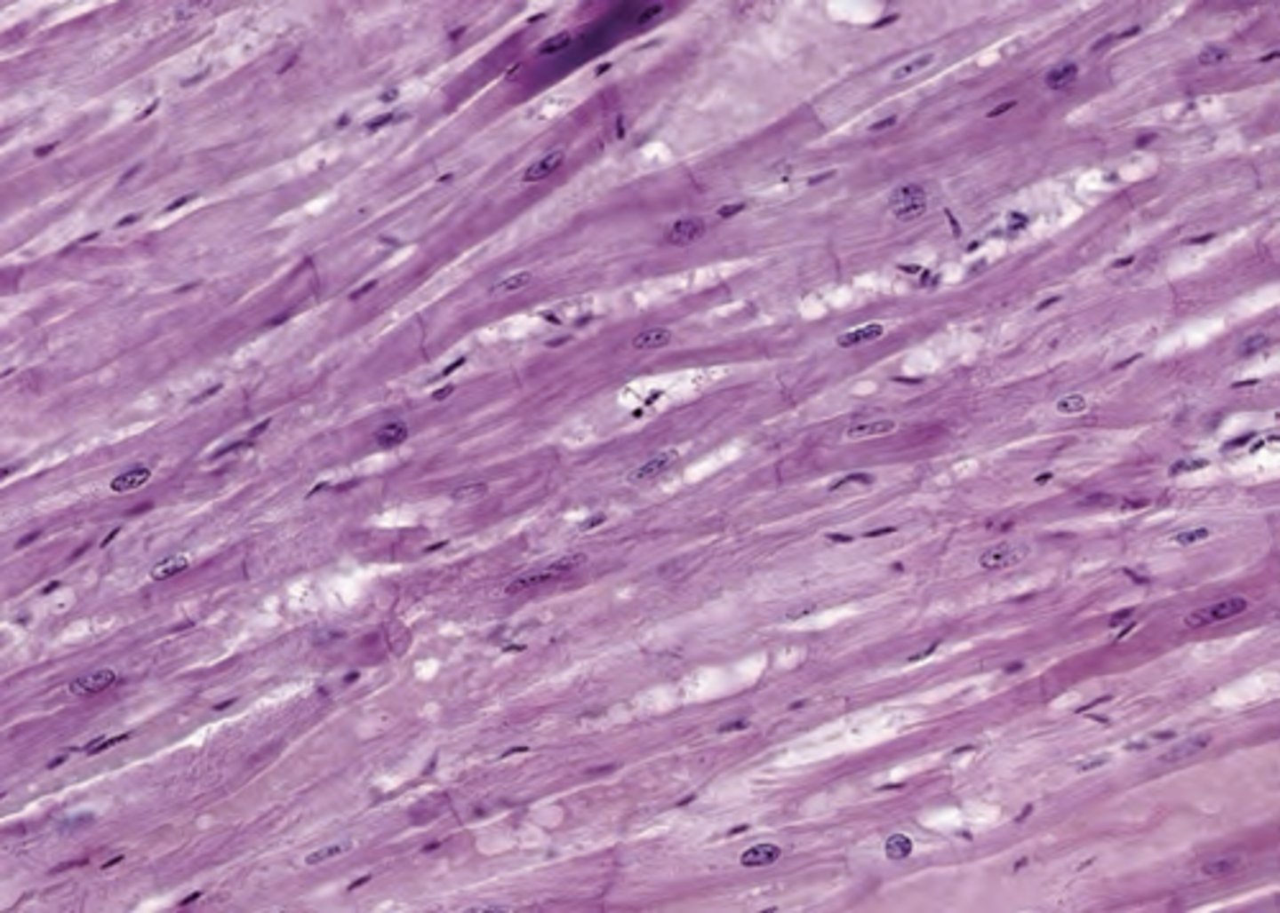 <p>The myocardium of a woman who died of a cardiac arrhythmia is examined in the pathology department (shown in the image). Which of the following statements describes an important feature of cardiac muscle that helps distinguish cardiac from skeletal muscle in routine H&amp;E slide preparations?</p><p>(A) Connective tissue contains a rich capillary network.</p><p>(B) Muscle fibers are composed of multiple cells.</p><p>(C) Muscle fibers exhibit cross-striations.</p><p>(D) Sarcomeres are located between adjacent Z lines.</p><p>(E) Thin filaments contain actin.</p>