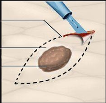 <p>When only a sample of tissue is removed with preservation of the histological architecture of the tissue’s cell</p>