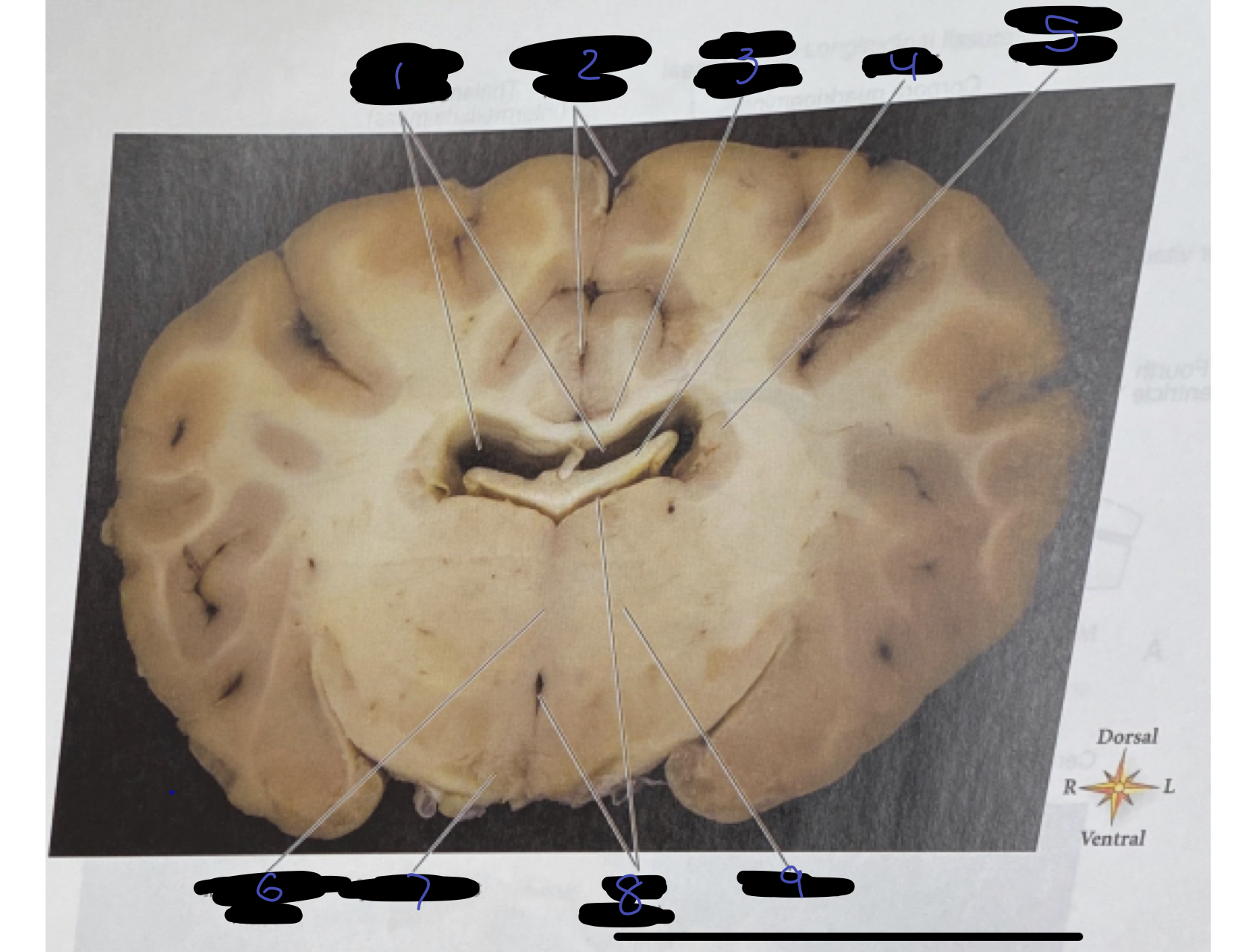 <ol><li><p>lateral ventricle</p></li><li><p>longitudinal fissure</p></li><li><p>corpus callosum</p></li><li><p>fornix</p></li><li><p>caudate nucleus</p></li><li><p>intermediate mass</p></li><li><p>hypothalamus</p></li><li><p>third ventricle</p></li><li><p>thalamus</p></li></ol>