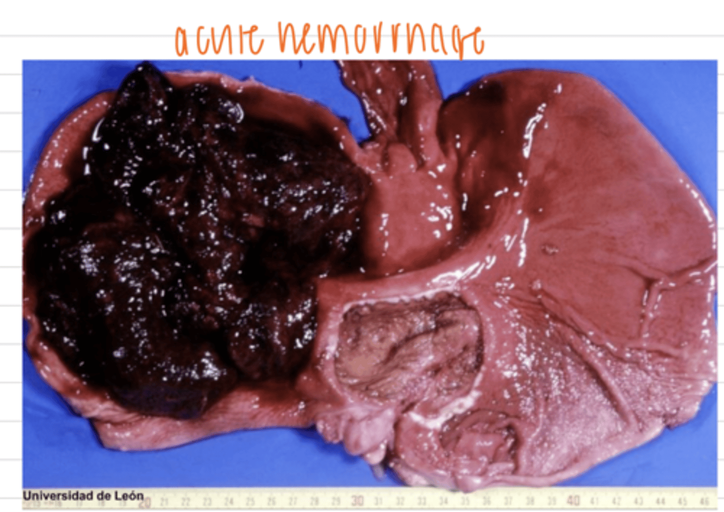 <p>acute, because it is the loss of a large volume of blood in a short amount of time, so the body does not have much time to adapt, which can lead to hypovolemic shock.</p><p>chronic hemorrhage is slower, so the body can adapt by increasing RBC production- it can lead to anemia, but is survivable</p>