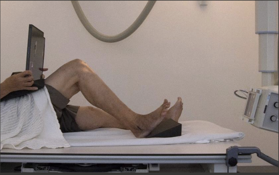 <p>Fine FS, 100cm</p><p>65kVp, 5mAs</p><p>Tube angle 10-15 degrees inferosuperiorly</p><p>CR:&nbsp;patellar apex</p>