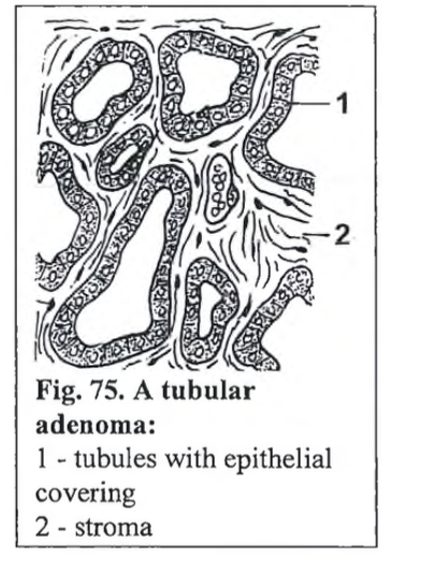 <p><strong>Adenoma et adenocarcinoma sebaceous gland</strong></p><img src="https://knowt-user-attachments.s3.amazonaws.com/3ffa8b17-d888-4993-95dd-d38710549ac4.png" data-width="100%" data-align="center"><p></p>