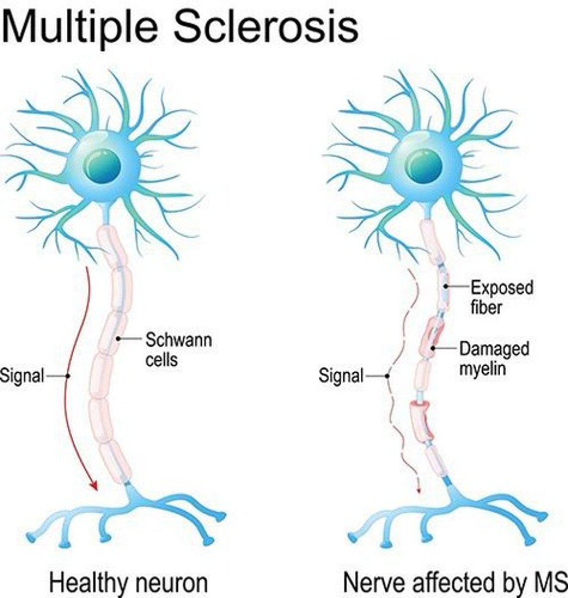 <p>Common CNS disease with demyelination patches.</p>