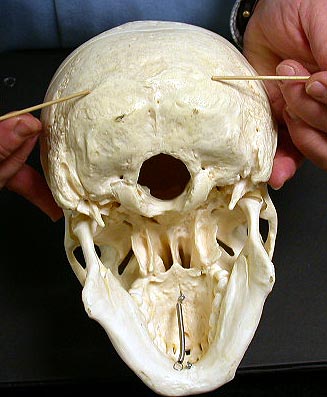 in occipital bone 