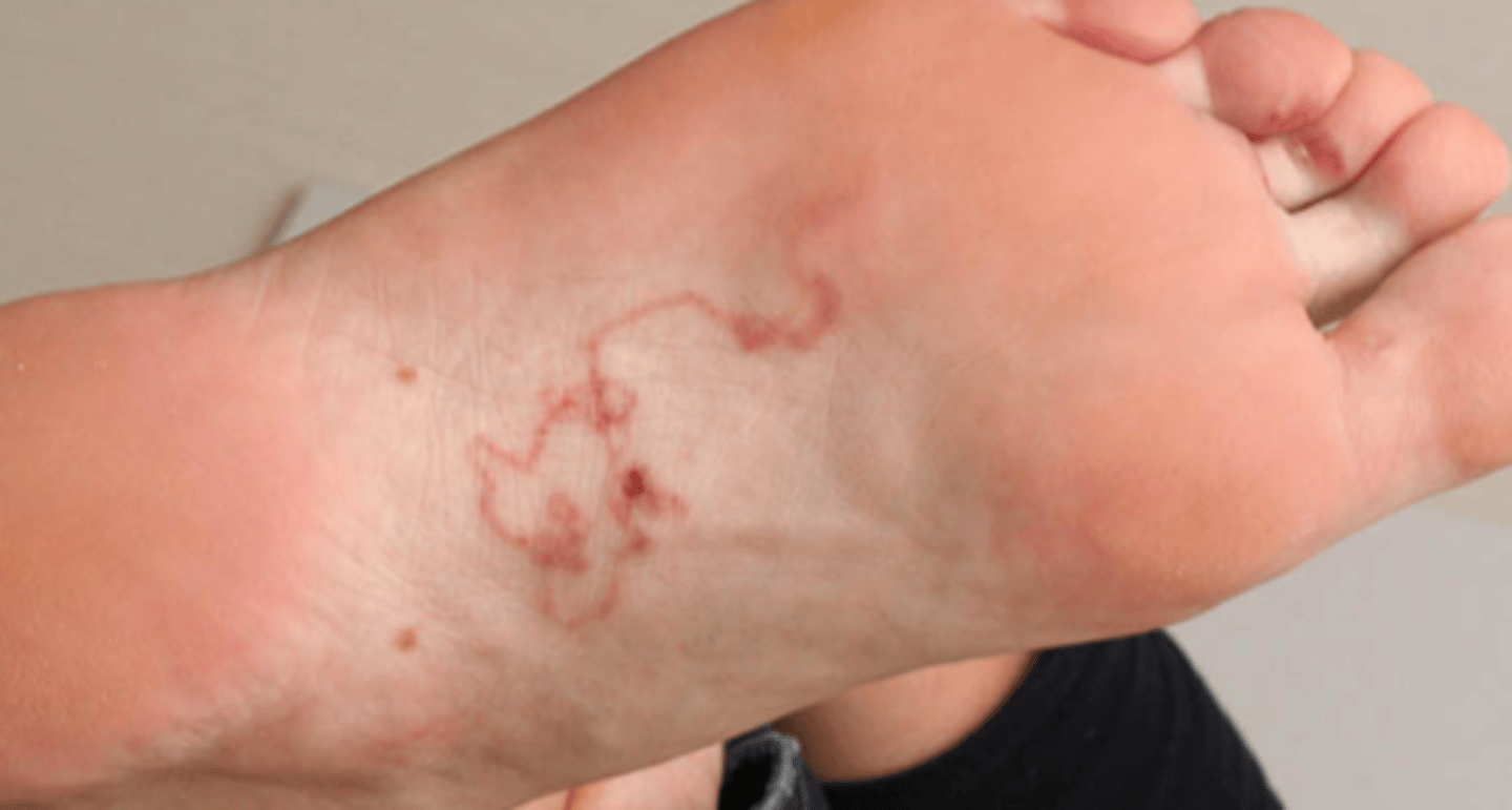 <p>Cutaneous larva migrans</p>
