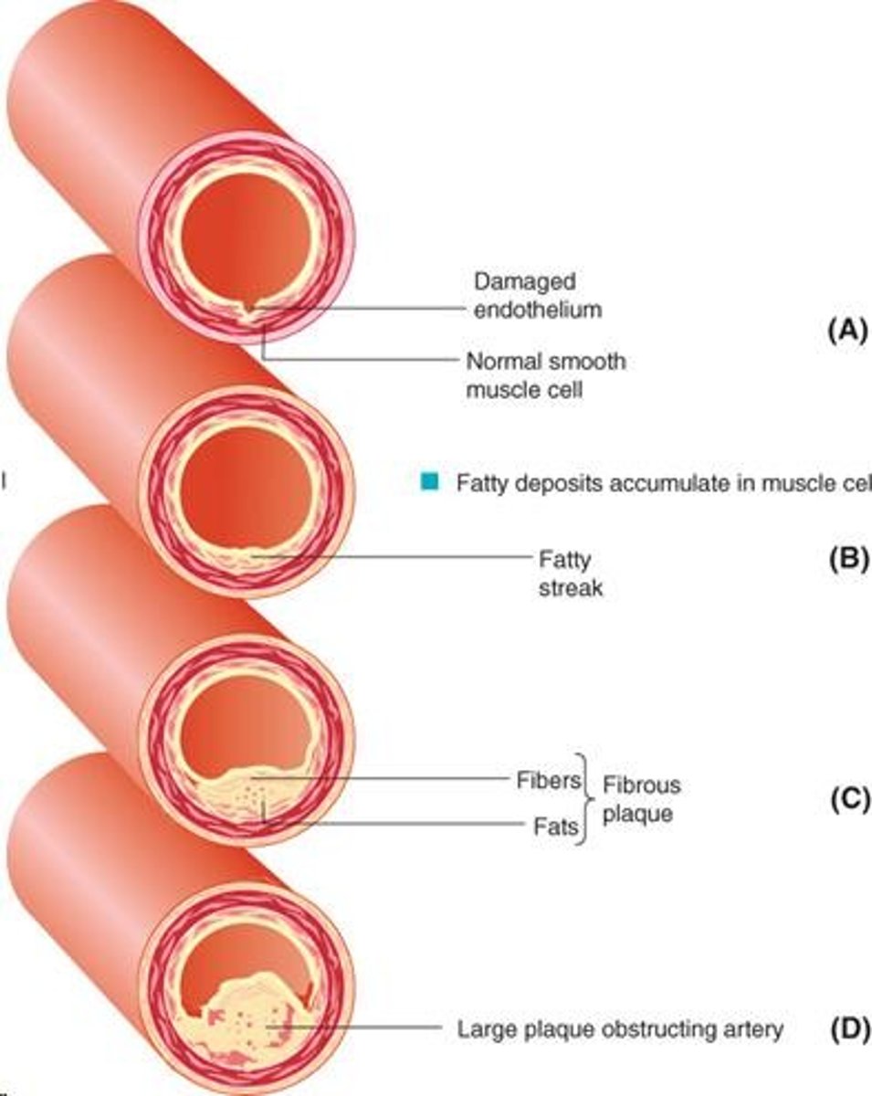 <p>the artery walls become progressively thickened due to an accumulation of fatty deposits, fibrous tissue and smooth muscle cells (collectively known as plaque)</p>