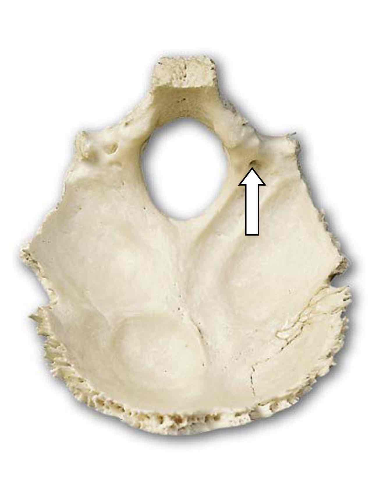 <p>Name the cranial nerve that passes through this hole and its roman numeral</p>