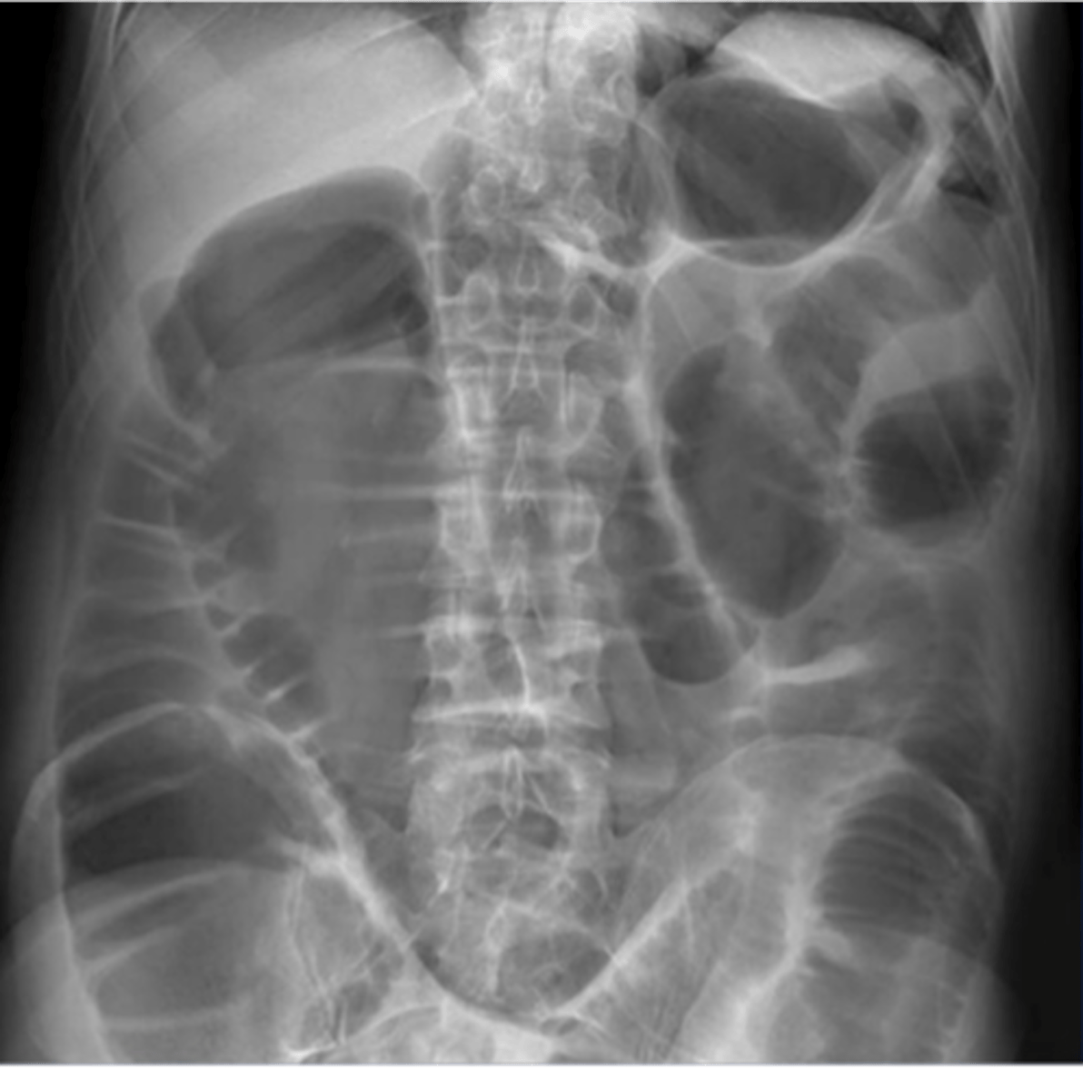 <p>entire bowel is aperistaltic, swallowed air dilates and fluid fills most loops of both small and large bowel</p><p>on imaging entire bowel is air-containing and dilated, air fluid levels, gas in rectum or sigmoid</p>