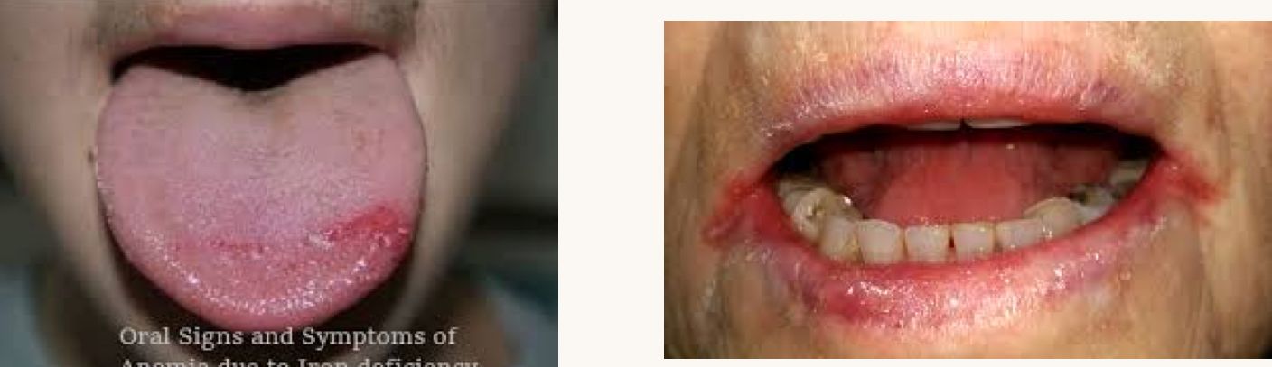 <p>what is this condition and what mineral is this person likely deficient in?</p>