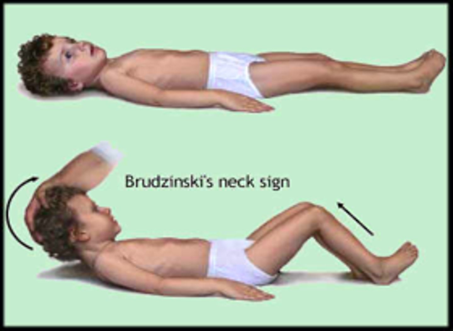 <p>Spontaneous flexion of hips during passive flexion of neck</p>