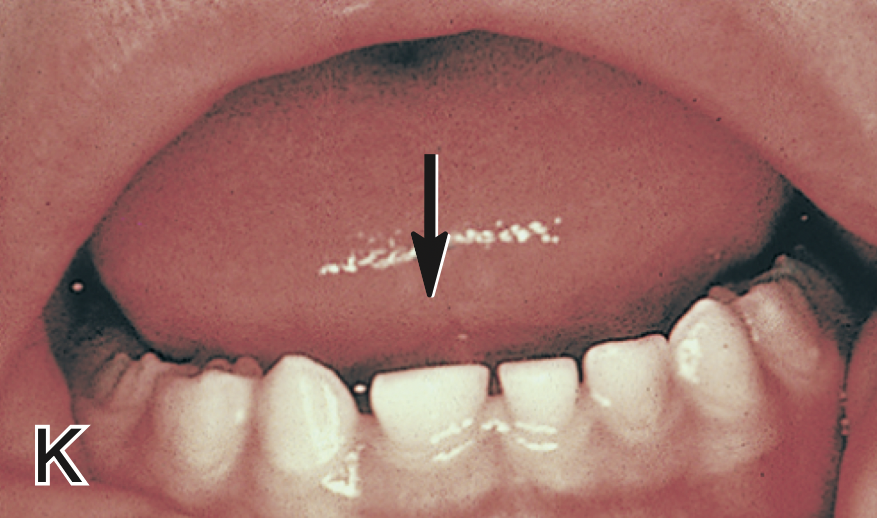 <p>What is <mark data-color="red" style="background-color: red; color: inherit;">fusion</mark> in teeth?</p>