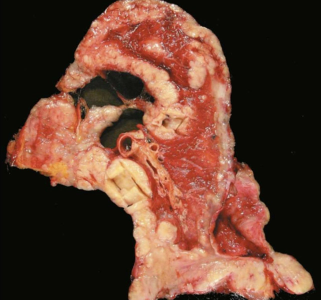 <p>mesothelioma</p><p>*rare but strongly associated w/ asbestos exposure--&gt; long latent period up to 40 yrs</p>
