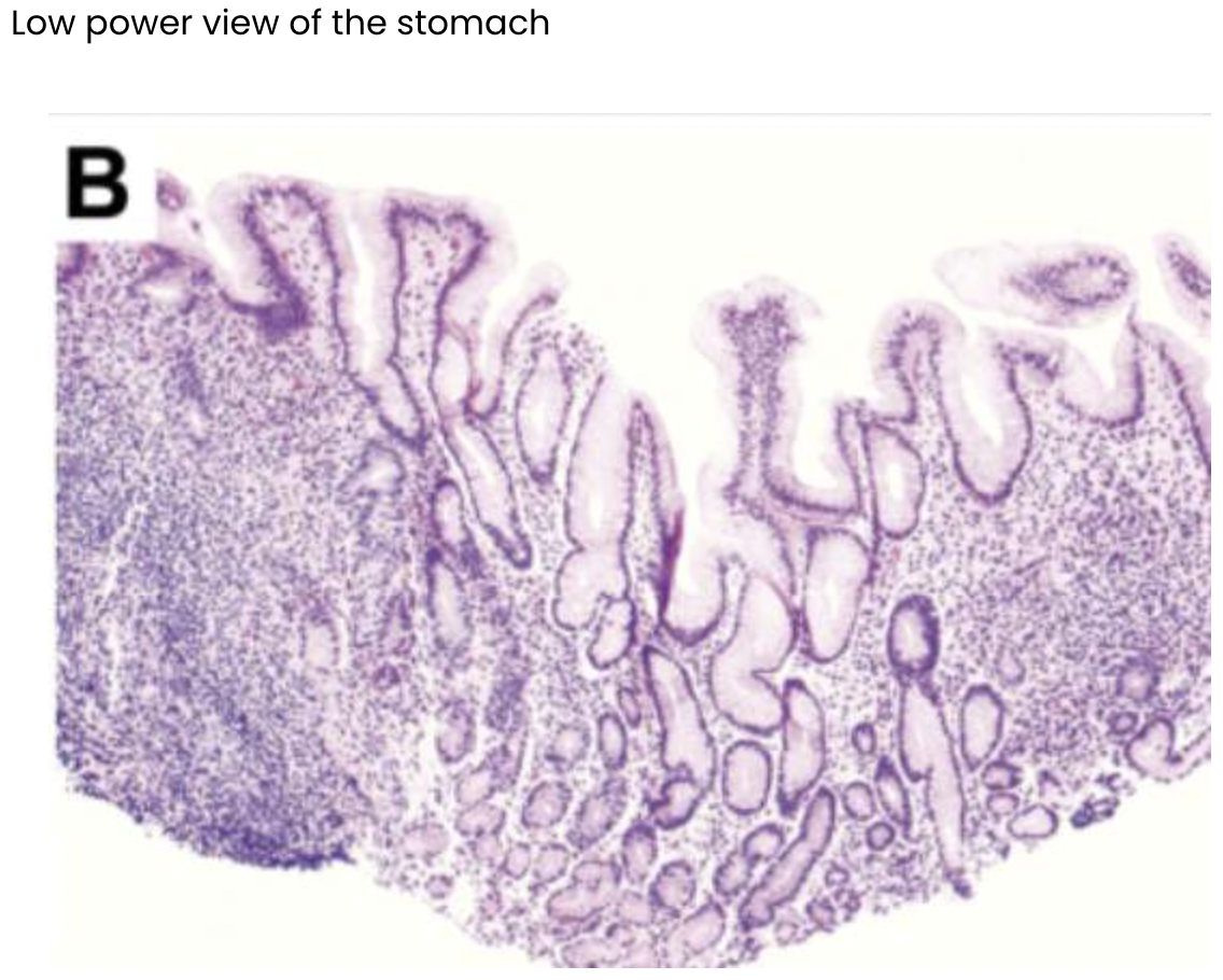 <p>Loss of folds</p><p>Inflammation</p><p>Lymphocytes </p>