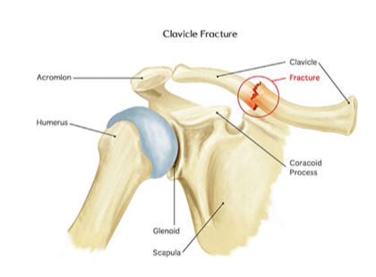 <p>Clavicle Fx </p>