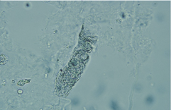 <ul><li><p>Seen with infection and inflammation of the nephron</p></li><li><p>Pyelonephritis: WBC casts, bacteria</p></li><li><p>Acute interstitial nephrtitis: WBC casts, no bacteria</p></li><li><p>May accompany RBC casts in glomerulonephritis</p></li><li><p><span>Mostly neutrophils and lobed nucleus and granules are seen</span></p><img src="https://knowt-user-attachments.s3.amazonaws.com/8d12d06a-0f7c-4c96-827a-46085ddce2ba.png" data-width="100%" data-align="center"></li></ul><p></p>