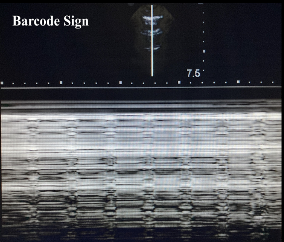 <p>What does the barcode sign indicate?</p><p>*seen in M mode</p>