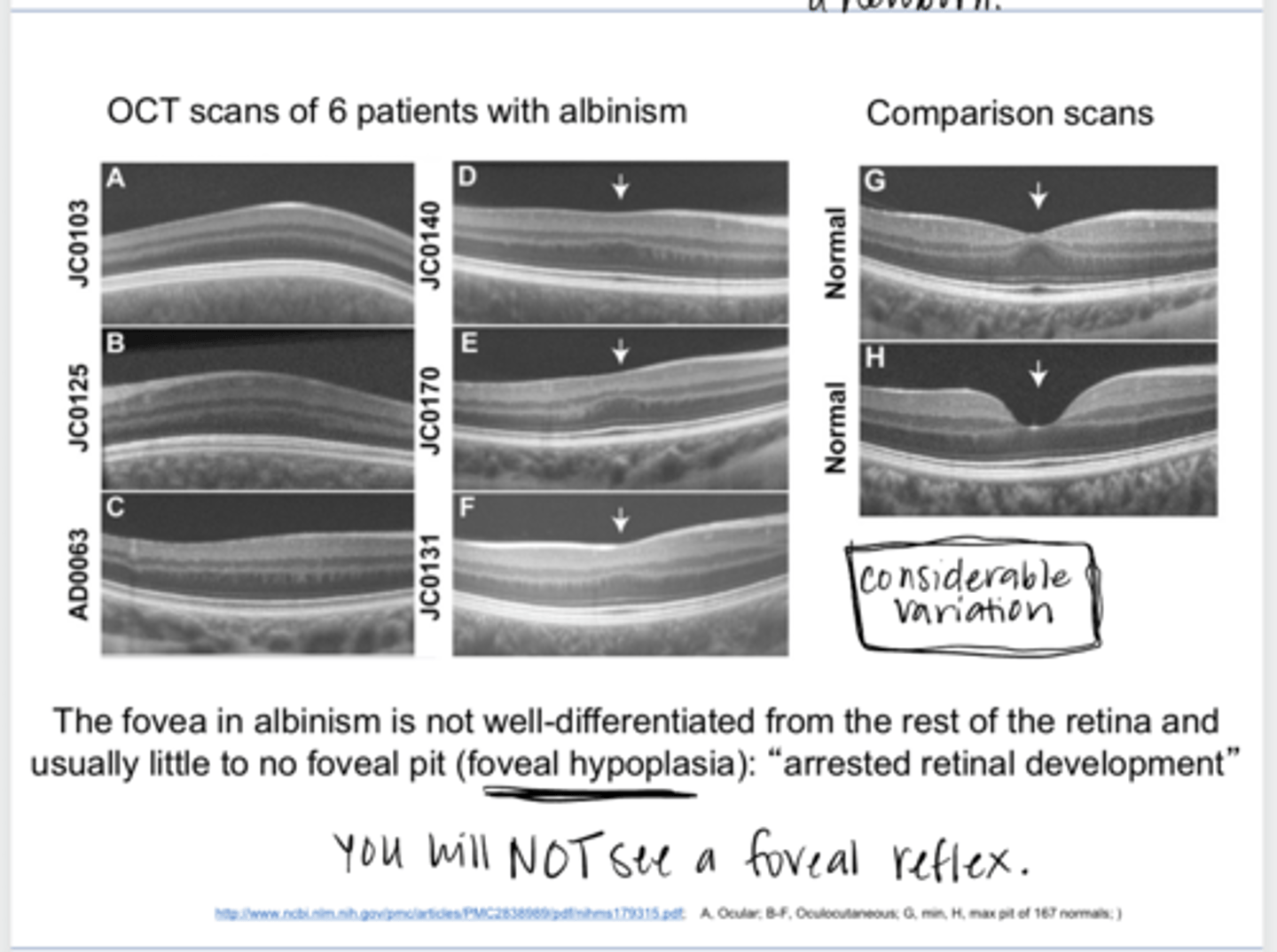 <p>Is the fovea in an individual with albinism well-differentiated from the rest of the retina?</p>