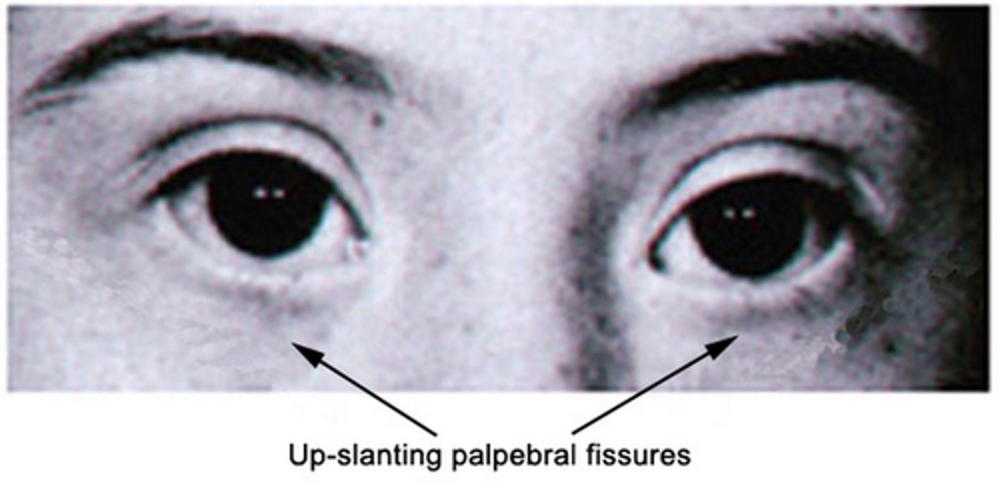 <p>spaces between the eyelids, should be equal in size</p><p>- indicates down syndrome</p>