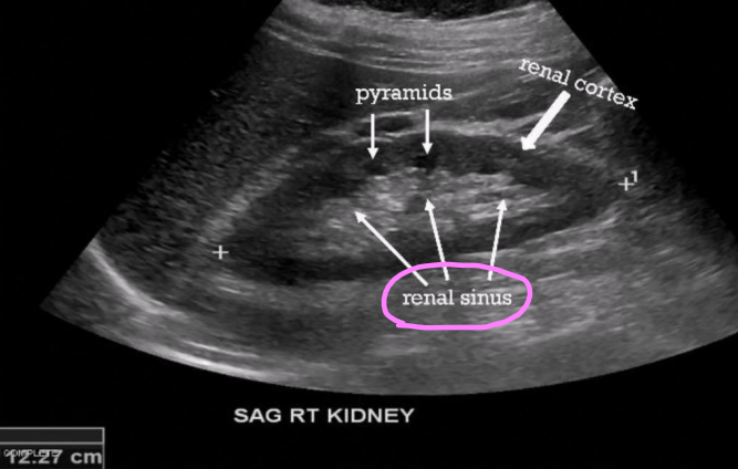 <ul><li><p>Cavity that contains the renal artery and veins and collecting and lymphatic system</p></li><li><p>Largely made up of fat and fibrous tissue </p></li><li><p>Appears brightly echogenic on sonographic imaging</p></li></ul><p></p>