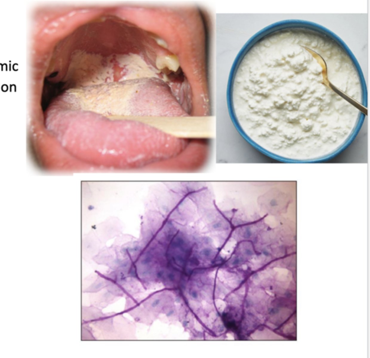 <p>oral mucocutaneous candida infection = oral thrush --&gt; fungal infection, can be chronic or acute; local or systemic</p><p>*presents as creamy white/yellow curd like plaques on the tongue/oral mucosa</p><p>-often asymptomatic</p><p>-symptoms --&gt; "cotton mouth", loss of taste, odynophagia</p><p>-can accompany esophageal candidasis</p>