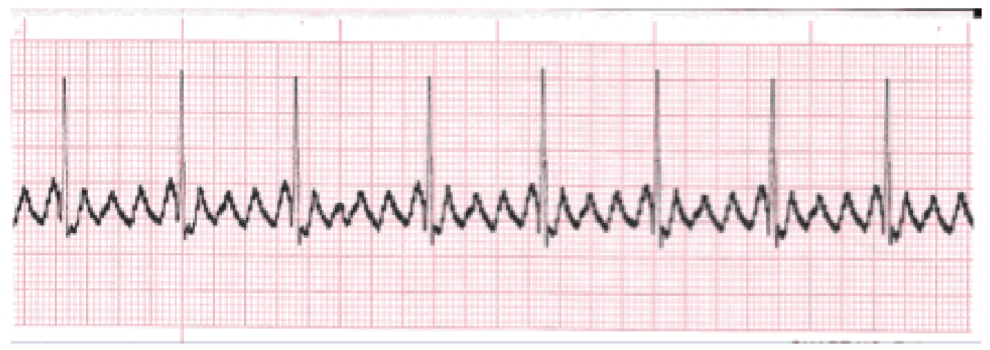 <p>What is the rhythm?</p>