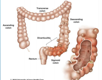 <p><strong>Diverticular Disease</strong></p><p>-Can occur ____________ in GI tract</p><p>-____ colon most common in Western countries (_______ most common) </p><p>-Right colon most common in Asian countries </p><p>-Small intestines is very rare </p>