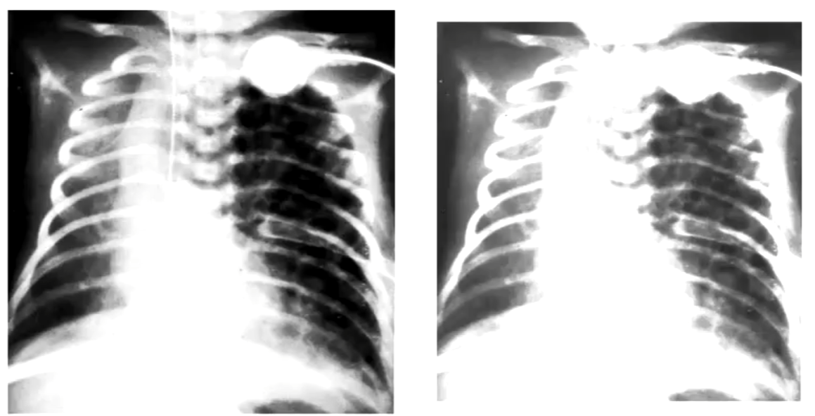 Honey comb appearance on left lung and increase in left lung volume resulting in right mediastinal shift