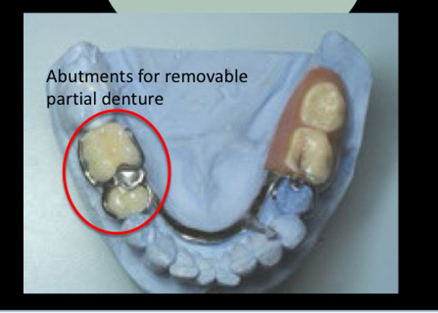 <p>Abutment teeth for removable partial dentures indications (2nd year)</p>