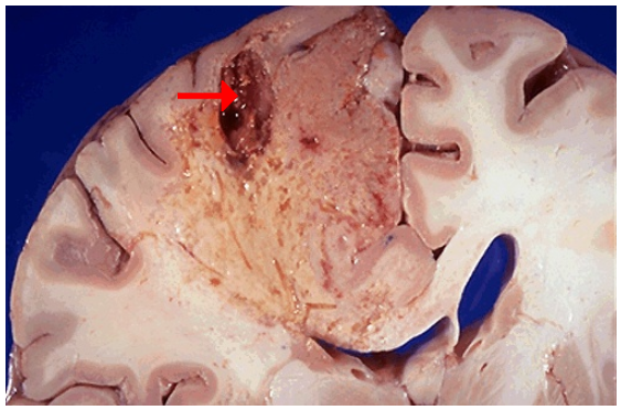 <p>1.Resolution of a liquefactive necrosis in the brain leads to the development of?</p>