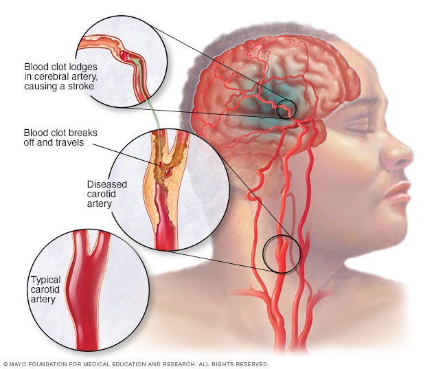 <p></p><ul><li><p>Ischemic strokes are caused by blocked arteries (87% of all strokes)</p></li><li><p>Hemorrhagic stokes are caused by “brain bleeds” or aneurism (13% of all strokes)</p></li><li><p>Symptoms include trouble walking, speaking, and understanding, as well as paralysis or numbness of the face, arm, or leg</p></li><li><p>those who are overweight, inactive, drink lots of alcohol, use recreational drugs, have high cholesterol, hypertension, poorly controlled diabetes, obstructive sleep apnea, or heart disease are at greater risk</p></li></ul>