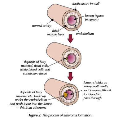 <p>if damage occurs in the endothelium, white blood cells and lipids from the blood clump together under the lining to form fatty streaks. over time, this hardens to form a plaque called an atheroma</p>