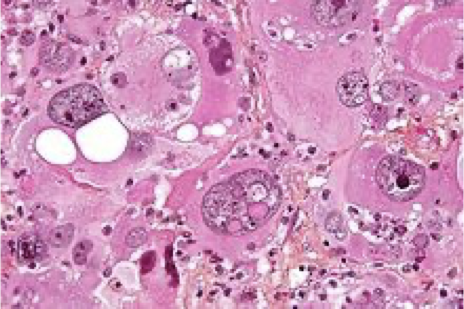 <p>What does this refer to</p><ul><li><p>May contain cystic material, calcium deposits, blood vessels and/or mixed grade of cells</p></li></ul><p></p>