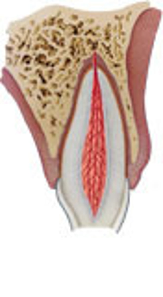 <p>fracture involving loss of enamel and dentin</p>
