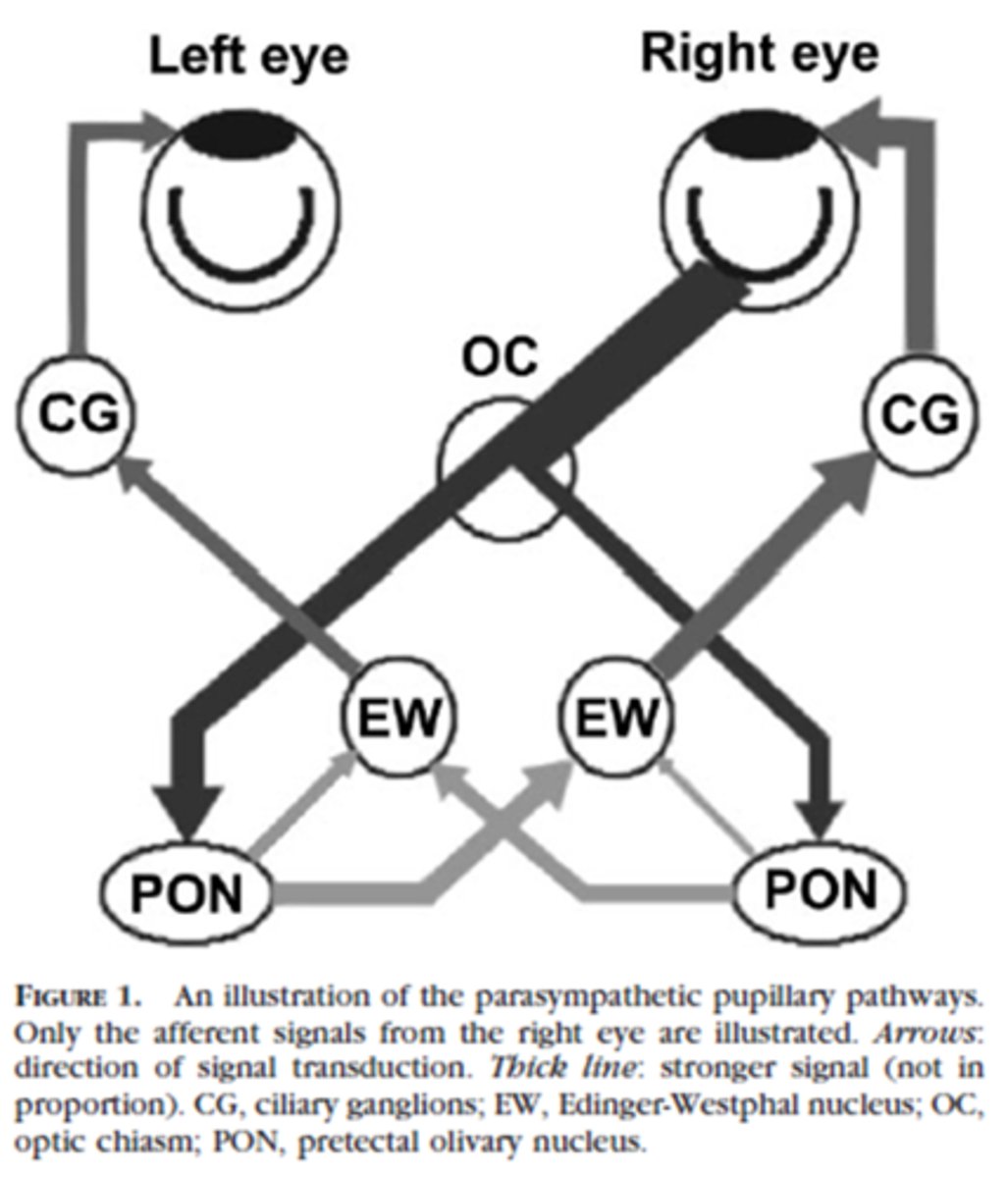 <p>pupil size obtained when shining light into direct eye is different than the consensual response obtained in the other eye (even if you didn't see aniso before this)</p><p>can be bilateral (doesn't matter which eye) or unilateral (ony occurs in one eye)</p>