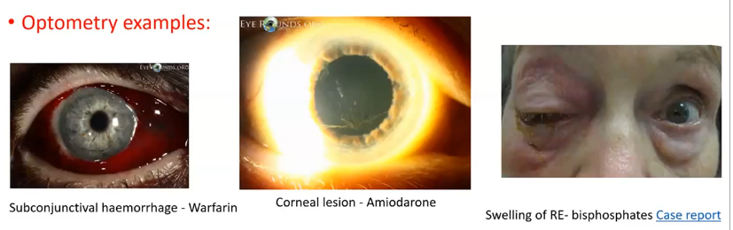 <p>a response to a medicinal product which is noxious and unintended (MHRA)</p><p>eg:</p><p>is px taking warfarin, likely to develop subconjunctival haemorrhages </p><p>amiodarone- can cause corneal lesions </p><p>biphosphates: swelling of the eye </p><p></p>
