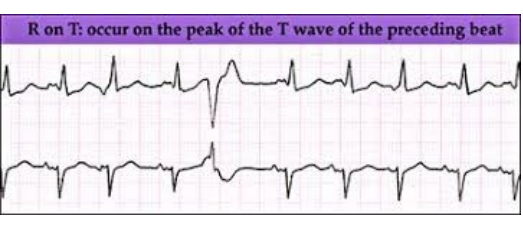<p>What does this EKG show?</p>