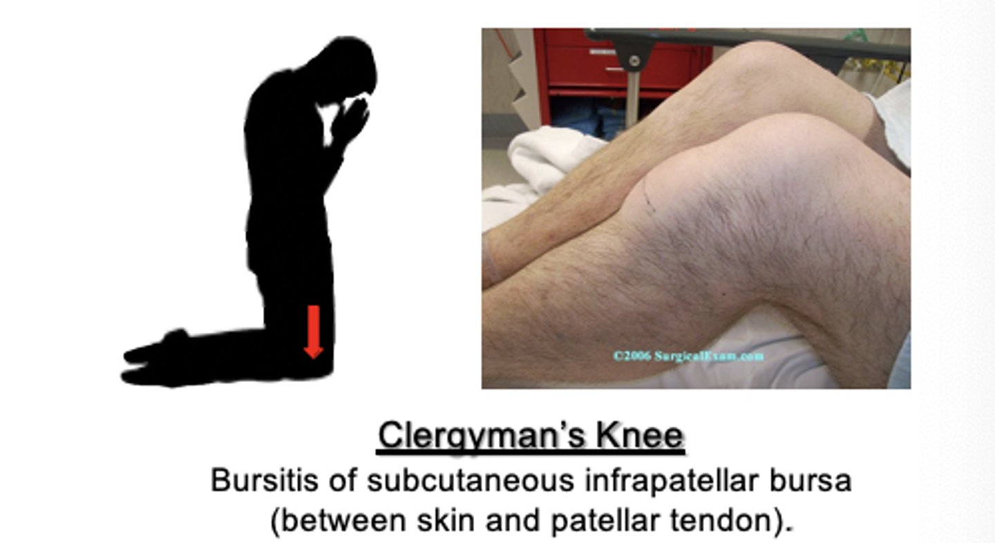 <p>- also known as "clergyman's knee"</p>