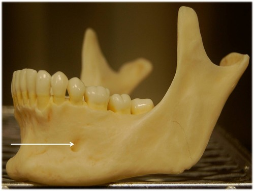 <p>Prominent opening on the body (lateral to the midline) that transmits the mental blood vessels and nerve to the lower jaw)</p>