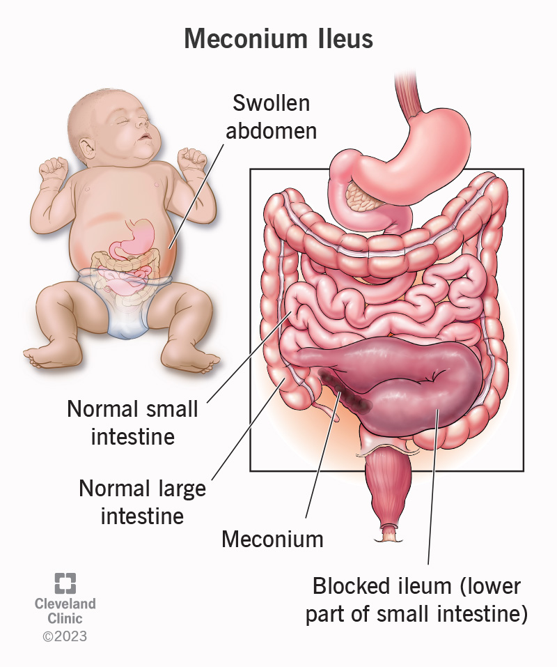 <p><strong>Fetal excrement</strong> found in <strong>amniotic fluid</strong>, typically present in <strong>very late pregnancy</strong>.</p>