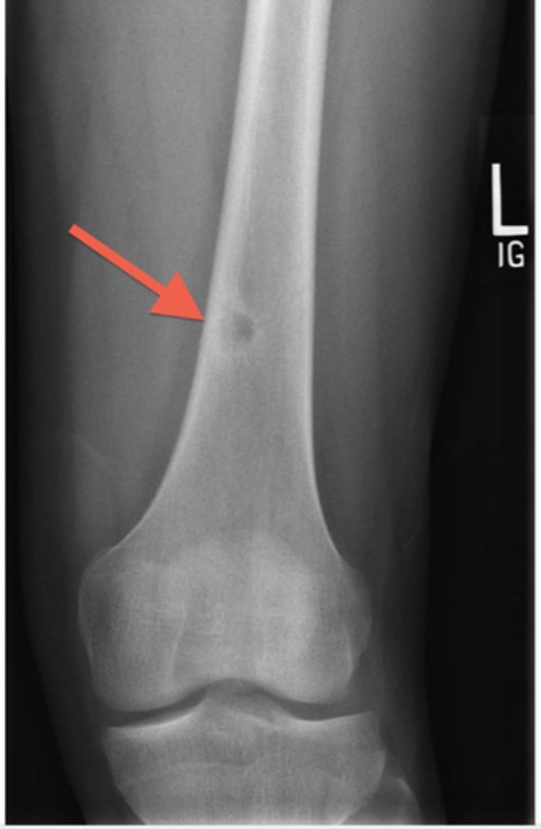 <p>appears as sclerotic ,cortical lesion on imaging with a central nidus of lucency. Typpically causes pain that is worse at night and unrelated to activity. However, the pain is quickly relieved by Nonsteroidal antiinflammatory medications</p>