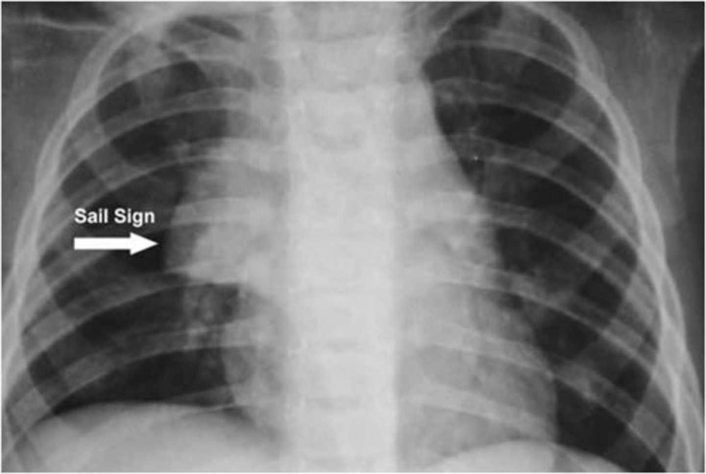 <p>Thymus</p><p>- triangular shape, scalloped border, uniform density</p><p>- anterior mediastinum behind sternum + front of the heart, aortic arch, trachea</p>