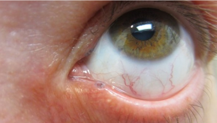 <ul><li><p><strong><mark data-color="#ffffff" style="background-color: rgb(255, 255, 255); color: inherit;">Punctual occlusion </mark></strong>(plastic plug)</p></li></ul><p></p><ul><li><p><strong>moisture chamber spectacles/goggles </strong>(expensive)</p></li></ul><p></p>