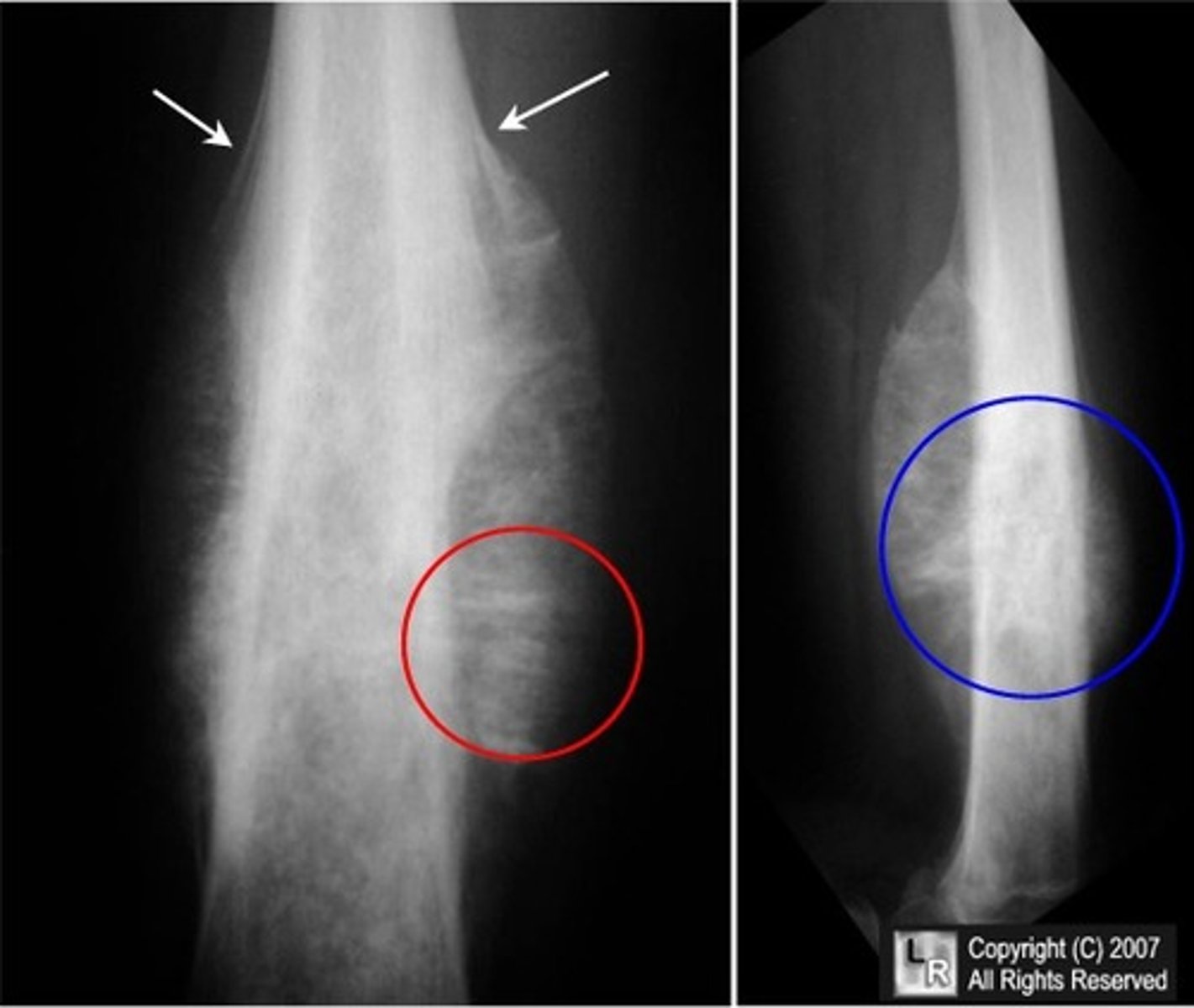 <p>Ewing sarcoma</p>