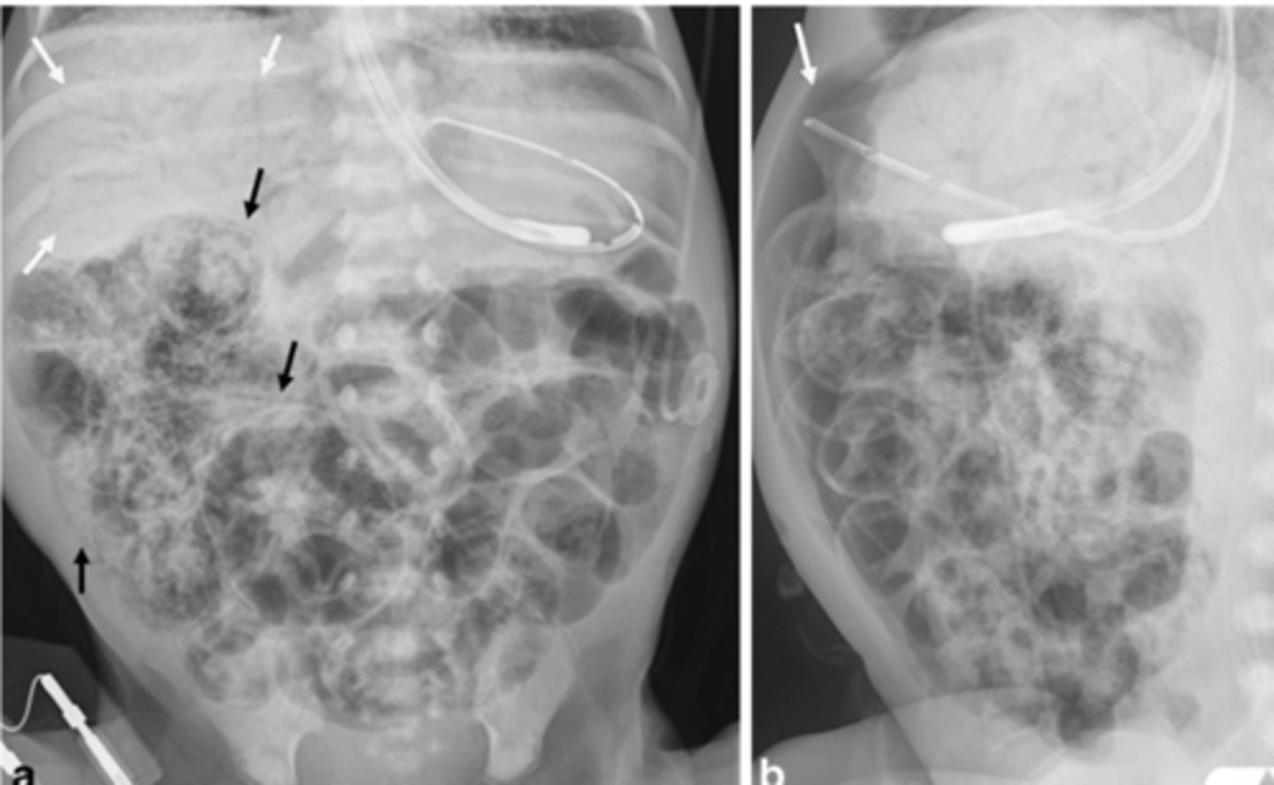 <p>-abdominal plain film series</p><p>-pneuatosis intestinalis</p><p>-tx: removal of necrotic bowel and ostomy vs end to end anastomosis</p>